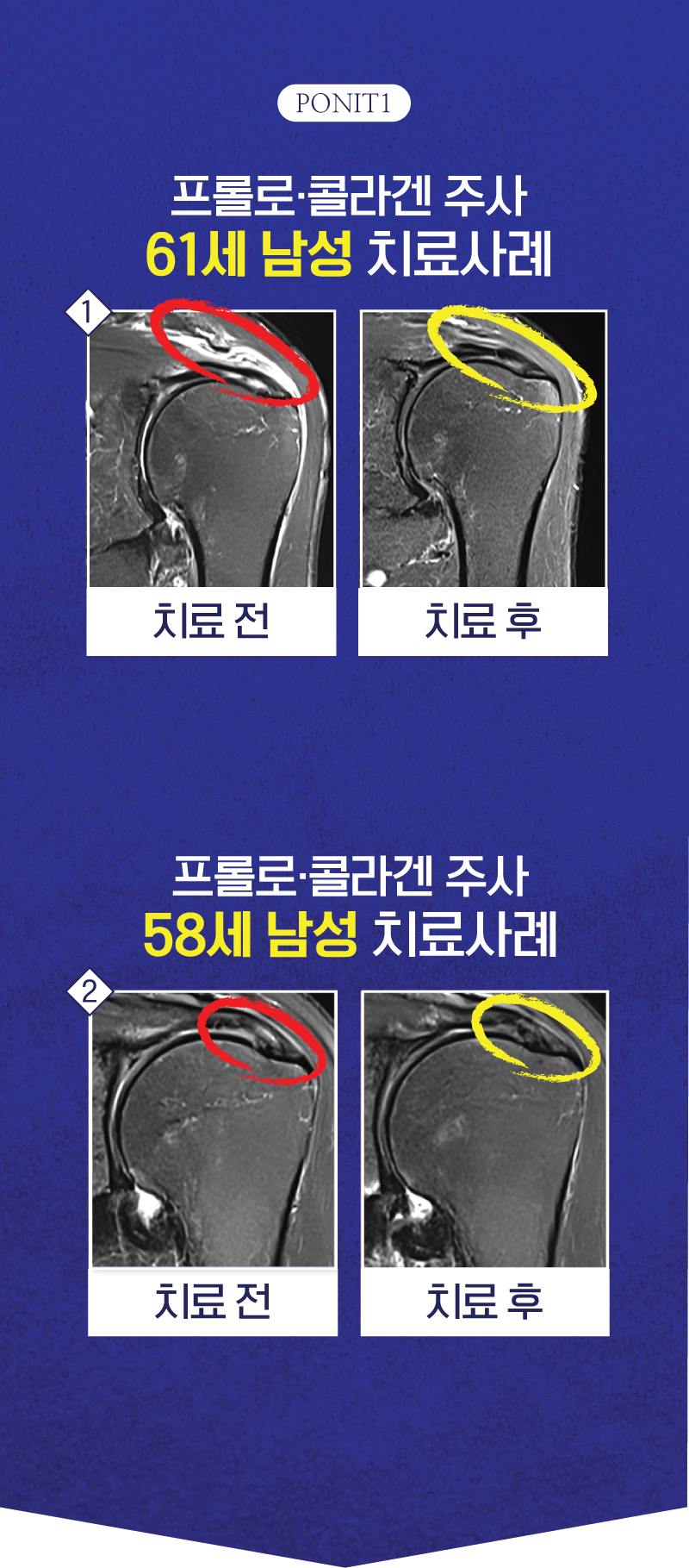 프롤로 콜라겐 주사